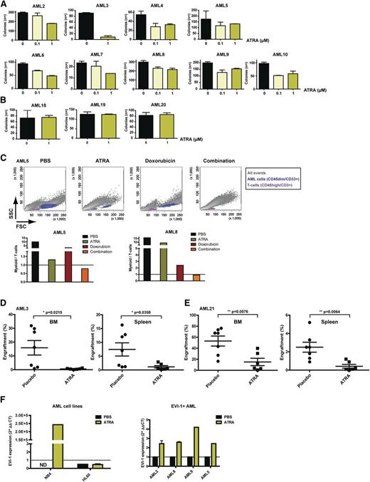 Figure 2. ATRA reduces colony-forming capacity and in vivo leukemic engraftment of EVI-1–positive cells. Number of colonies generated from EVI-1–positive (A) and EVI-1–negative (B) AML cells after 7 days of treatment with the indicated concentrations of ATRA. Bars represent the average numbers of colonies from a duplicate, and error bars indicate the standard deviation. AML11 to 14 did not show colonies. (C) Flow cytometric analysis (upper panels) of cells treated with 1 µM ATRA (4 days), 0.5 µM doxorubicin (3 days), or the combination (pretreatment with ATRA) and the quantification (lower panels) of myeloid (CD33+/CD45dim/CD3−) (blue) and lymphoid (CD33−/CD45high/CD3+) (purple) cells, which were negative for 7-AAD. (D-E) Quantification of human myeloid cells (hCD45dim/hCD33+) from BM and spleen of NSG mice injected with primary AML cells and treated with ATRA or placebo. (F) Quantitative reverse-transcription polymerase chain reaction analysis of EVI-1 expression upon 5 days of ATRA treatment of the AML cell lines NB4 and HL60 (left) and upon 7 days of ATRA treatment of EVI-1–positive AML cases (right).