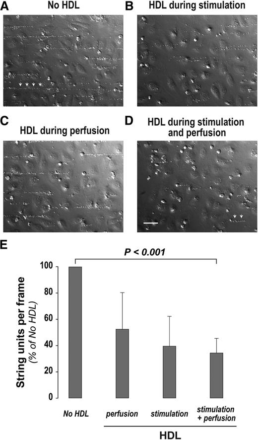 Figure 3. HDL reduces VWF string assembly on the endothelial surface. Human umbilical vein endothelial cells (HUVECs) cultured in parallel-plate flow chambers were stimulated with 50 ng/mL phorbol myristate acetate (PMA) for 20 minutes at 37°C under static conditions, with or without HDL (2 mg/mL). Two mL of formaldehyde-fixed platelets (7 × 104 platelets per μL) were then perfused over the stimulated cells at a shear stress of 10 to 20 dynes/cm2 with or without HDL (200 μg/mL). The cells were then washed and fixed with paraformaldehyde. The platelet-decorated VWF strings in 10 random, nonoverlapping bright-field images for each condition were counted and measured. HUVECs were stimulated with PMA and perfused with fixed platelets (A) in the absence of HDL, (B) in the presence of HDL during stimulation but not perfusion, (C) in the presence of HDL during perfusion but not during stimulation, and (D) with HDL present during both stimulation and perfusion. (E) Quantification of VWF string units on the endothelial surface (n = 3 to 6). P value (<.001) is from Welch’s t test with Bonferroni correction for the comparison of means for no HDL vs HDL during stimulation and perfusion. Platelet-decorated VWF strings are indicated by arrows in (A) and (D). Scale bar, 50 μm (A-D).