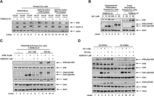 Figure 1. ATR signaling is activated in response to replication stress in proliferating primary CLL cells and is inhibited by AZD6738. (A) Stimulation of primary CLL cell proliferation by coculture with CD40L-expressing murine embryonic fibroblasts in the presence of IL-21 (CD40L/IL-21) for 4 days resulted in induction of ATR expression in primary CLL cells irrespective of ATM or TP53 status. Cyclin A expression is a marker of proliferating cells. Actin is the loading control. (B) Cryopreserved or fresh primary CLL cells cultured with or without CD40L/IL-21 (lanes 1-4 and 9 and 10, and lanes 5-8, respectively) were treated with HU. Cryopreserved samples not cocultured with CD40L/IL-21 were resuspended and preincubated in culture media for 24 hours prior to treatment (lanes 5 and 6), whereas fresh cells were treated immediately upon isolation from peripheral blood without preincubation (lanes 7 and 8). Exposure to HU (1 mM), which induces replication stress, led to Chk1 phosphorylation in primary CLL cells cocultured with CD40L/IL-21 (lanes 2, 3, and 10). (C) TP53/ATM wild-type (TP53/ATM-wt) primary CLL cells cocultured with CD40L/IL-21 (C) and CII cells (D), both CII-GFPsh and CII-ATMsh, were treated with AZD6738 (1 μM) and/or the ATM inhibitor KU-55933 (ATMi; 10 μM) for 2 hours, or left untreated, prior to exposure to HU (1 mM) or IR (6 Gy) for a further 5 hours. AZD6738 treatment inhibited ATR signaling as indicated by a reduction in HU-induced Chk1 phosphorylation (panel C, lane 4 vs 6; panel D, lanes 3 vs 4 and 9 vs 10). In ATM-proficient CLL cells, this also led to ATM activation as evidenced by ATM phosphorylation and Chk2 phosphorylation (panel C, lane 4 vs 6; panel D, lane 3 vs 4). In panels B-C, representative blots from experiments on 3 CLL samples are shown.