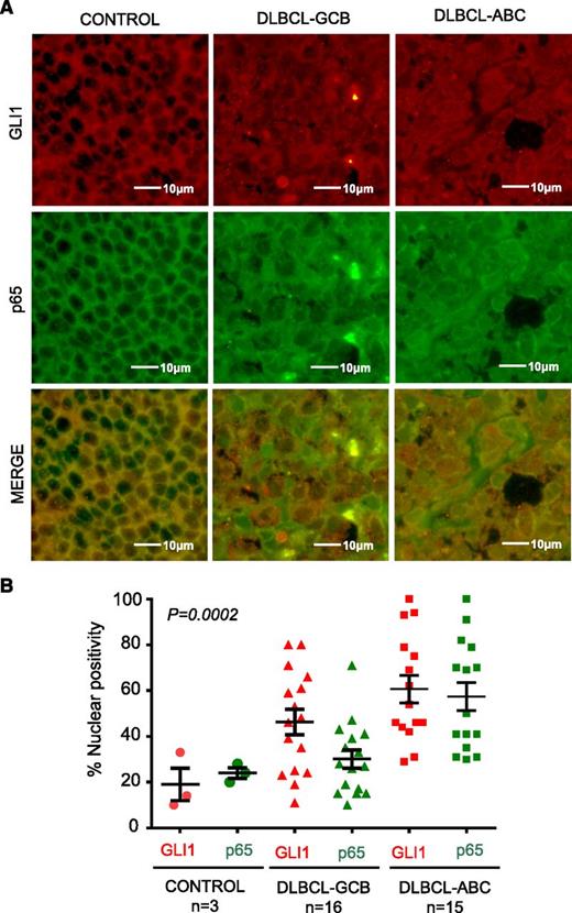 Figure 6. Clinical correlation between activated NF-κB and noncanonical Hh signaling pathways. (A) Immunofluorescence analysis of p65 and GLI1 in non-neoplastic lymph nodes and DLBCL tumors. Non-neoplastic lymph nodes (controls) and DLBCL tissue sections were stained with GLI1 (red) and p65 (green) antibodies. (B) The diagram shows the correlation between GLI1 and p65-integrated nuclear density expression (percentage) in GCB (n = 16) and ABC (n = 15) DLBCL subtypes.