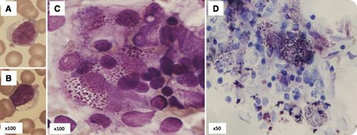 A 6-year-old girl from Pakistan was investigated for neurologic symptoms also affecting 3 other family members. She was the sixth child of parents who were first cousins, born at term with normal birth weight. Developmental milestones were normal until 5 years old when she developed restless behavior, loss of motor skills, stiff gait, muscular spasticity, hepatosplenomegaly, and dysmorphic facies: bushy eyebrows, low forehead, and a short pouting upper lip. Her blood count was normal but morphology revealed 20% lymphocytes with between 1 and 9 cytoplasmic vacuoles (panels A-B). Bone marrow was normocellular with normal trilineage maturation. Some bone marrow lymphocytes also showed cytoplasmic vacuolation. Macrophages visible in and around the edges of the particles were of normal size, nonvacuolated but with abnormal basophilic cytoplasmic inclusions (panel C). Staining with toluidine blue (of Haust and Landing) confirmed the presence of metachromatic acid mucopolysaccharide granules (panel D), which are typical of some types of mucopolysaccharidosis (MPS) storage disorder. / Morphology provides an important rapid diagnostic assessment but must be confirmed by appropriate biochemical and molecular tests. Peripheral blood vacuolation is a useful differentiating feature between storage disorders; the absence of Alder granulation in maturing myeloid cells distinguishes MPS type III (Sanfilippo syndrome) from MPS type VI.