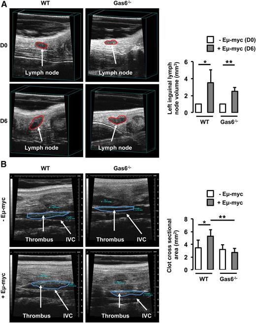 Figure 2. Gas6 deficiency also protects mice against B-cell lymphoma. (A) Lymph node volume was measured in the same mouse prior to (D0) and after (D6) the injection of Eμ-myc B-cell lymphoma. Lymphoma significantly increased lymph node size in WT and Gas6−/− mice after 6 days. (B) Eμ-myc B-cell lymphoma significantly increased thrombus cross-sectional area in the IVC of WT mice but not in the IVC of Gas6−/− mice. *P < .05 comparing WT vs WT + Eμ-myc; **P < .05 comparing WT + Eμ-myc vs Gas6−/− + Eμ-myc, and Gas6−/− vs Gas6−/− + Eμ-myc. D0, day 0; D6, day 6.