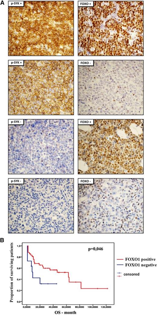 Figure 6. Expression and clinical significance of FOXO1 in primary DLBCLs. (A) Immunohistochemical analysis of FOXO1 and phospho-SYK (Y525/6) expression in DLBCL samples. Shown are representative cases with positive and negative staining. Pictures were taken with ×60 objective. For the tabular representation of the immunohistochemical analysis of FOXO1 and phospho-SYK expression performed in a panel of 60 DLBCL patients, please see supplemental Table 11. (B) Overall survival of DLBCL patients with respect to FOXO1 expression.