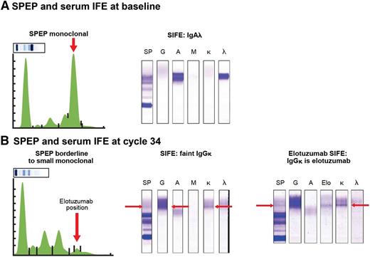 Figure 2. Elotuzumab can be detected in SPEP and IFE in samples from patients treated with elotuzumab. (A) Serum IFE detected an IgA-λ M-protein at baseline. (B) After 8 cycles of lenalidomide-dexamethasone and elotuzumab (ELOQUENT-2 study), there was development of a new IgG-κ band of 0 to 2 g/L. In the anti-elotuzumab assay, one of the anti-immunoglobulin antibodies (anti-IgM or anti-IgA) used to precipitate the immunoglobulins was replaced by an anti-elotuzumab antibody (2 mg/mL) with reactivity to an elotuzumab epitope. If elotuzumab is present in patient sera, the anti-idiotypic antibody-elotuzumab complex precipitates, and a band is detected. As elotuzumab is an IgG-κ monoclonal antibody, elotuzumab is precipitated by anti-κ and anti-γ heavy chain antisera, and the 2 bands should align with the elotuzumab band. Indeed, the anti-elotuzumab assay, performed at cycle 34, detected elotuzumab in the IgG-κ band. SIFE, serum immune fixation.