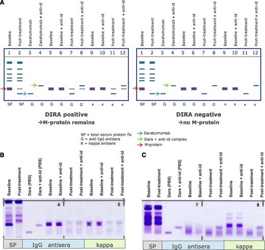 Figure 3. Management of interference of daratumumab with SPEP and IFE assays by using DIRA. (A) Schematic representation of DIRA for a DIRA-positive (left) and DIRA-negative case (right). (B) Example from a patient with IgG-κ M protein, who was treated with daratumumab. This patient developed a second IgG-κ band at the end of cycle 1. Response evaluation at start of cycle 16 demonstrated a decrease in M-protein from 31 to 0 g/L by SPEP analysis. Therefore, the DIRA assay was performed, which was positive, indicating that this patient had achieved a very good partial response. (C) Example from a patient with κ light chain MM, who was treated with daratumumab. This patient developed an IgG-κ band of 0 to 1 g/L at the end of the first cycle. The DIRA assay was performed at cycle 11 because of normalization of κ light chains with normal free light chain ratio. The DIRA assay was negative, which triggered bone marrow examination and showed no clonal plasma cells. Therefore, this patient had achieved stringent CR. The new IgG-κ band, which shifted after adding the anti-daratumumab antibody, represents daratumumab. anti-id, anti-idiotype.