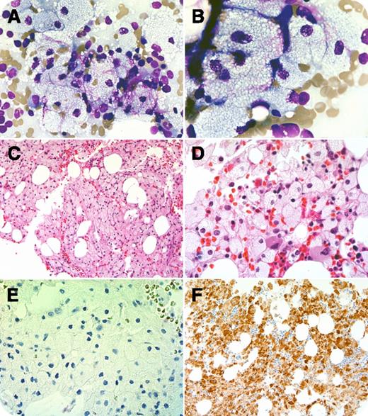 An asymptomatic 51-year-old man with familial hypertriglyceridemia presented with pancytopenia (white blood cells, 2.8 × 109/L; hemoglobin, 11.9 g/L; and platelets, 77 × 109/L). His only medications were 3 antihyperlipidemic drugs. Lymphadenopathies, hepatosplenomegaly, and/or bleeding were absent. Aside from elevated triglycerides (1739 mg/dL; normal range, 150-199 mg/dL), an extensive diagnostic workup was unremarkable. Bone marrow aspirate revealed panhypoplasia and increased histiocytes, which were remarkably large with abundant cytoplasmatic accumulation of foamy or lipid components resembling Niemann-Pick cells (panels A-B, Wright-Giemsa; magnification ×600 and ×1000, respectively). About 70% to 80% of marrow space was replaced with the abnormal histiocytes (panels C-D, hematoxylin and eosin; magnification ×200 and ×600, respectively). There was no evidence of hemophagocytosis, dysplasia, or blastosis. On immunohistochemistry, the histiocytes were CD1a− (panel E; magnification ×600), CD68+ (panel F; magnification ×600), and S-100−. Flow cytometry, cytogenetics, and stains for acid-fast bacilli and Gomori methenamine silver were normal. Finally, glucocerebrosidase and sphingomyelinase activity, and mutation analysis, excluded Gaucher and Niemann-Pick diseases. / Pseudo–Niemann-Pick cells (PNPCs) have characteristic vacuolated cytoplasm instead of the “striated” one of pseudo-Gaucher cells (PGCs). Also, PNPCs are seen in lipid diseases whereas PGCs are found in high cell turnover disorders (eg, acute leukemias, multiple myeloma, Langerhans cell histiocytosis, and mycobacterial infection). Familial hypertriglyceridemia with pancytopenia due to PNPC marrow infiltration has not been previously reported.