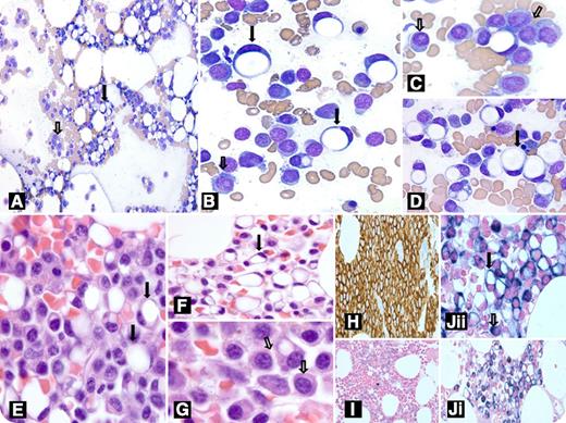 An 84-year-old man with a history of multiple myeloma presented to the emergency department with new-onset aphasia, worsening bilateral lower extremity weakness, and confusion of 3-day duration. Clinical examination and imaging studies ruled out an acute stroke. A complete myeloma workup was initiated. Laboratory results showed overall stable myeloma markers. Bone marrow examination revealed numerous plasma cells in both aspirate (panels A-D, open arrows) and biopsy specimens (panels E-G, open arrows). Additionally, numerous intermixed signet ring cells were also noted (panels A-G, closed arrows). These signet ring cells were completely vacuolated and lacked any cellular amorphous material. CD138 showed intense staining in both the plasma cells and signet ring cells (panel H); pancytokeratin was negative (not shown). Light chain in situ hybridization studies (panel I, κ; panel Ji, λ, original magnification ×400; and panel Jii, λ, original magnification ×1000) revealed intense λ cytoplasmic staining for plasma cells (Jii, open arrow) with predominantly peripheral membranous staining in the signet ring cells (Jii, closed arrow). / Plasma cells exhibit a spectrum of morphologic forms. Signet ring forms with cytoplasmic immunoglobulins are believed to be formed due to defective immunoglobulin assemblage. There are only rare case reports of plasma cells with true signet ring morphology. Because CD138 can be positive in epithelial malignancies, additional stains such as pancytokeratin should be performed to rule out underlying carcinoma. Additionally, the light chain staining pattern can further aid in differentiating these forms from those of signet ring carcinoma.