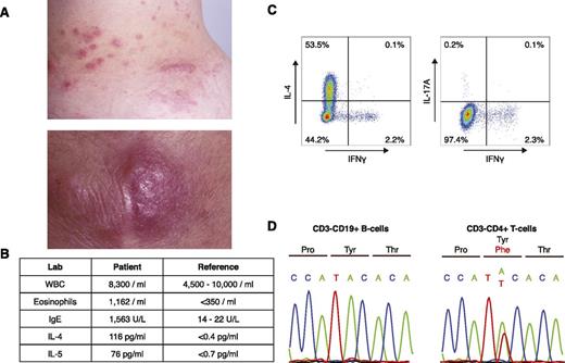Figure 1. Identification of a p.Y640F STAT3 mutation in a patient with L-HES. (A) Clinical photographs of eosinophil-infiltrated papules and nodules on the patient’s trunk (upper) and elbow (lower). (B) Table of relevant laboratory findings, with reference values. (C) Intracellular cytokine staining of CD3−CD4+ T cells. Peripheral blood mononuclear cells were stimulated for 5 hours with phorbol 12-myristate 13-acetate (50 ng/mL) and ionomycin (1 μg/mL). Cells were subsequently fixed, permeabilized, and stained with a phycoerythrin/cyanin 7–labeled anti-human CD3 antibody (BD Pharmingen) and an antibody cocktail containing antibodies for CD4, IL-4, IL-17A, and interferon-γ (IFNγ) (BD Pharmingen). (D) Confirmation of the somatic STAT3 mutation in CD3−CD4+ T cells by Sanger sequencing. Matched normal CD3+CD19− B cells were used as a control.