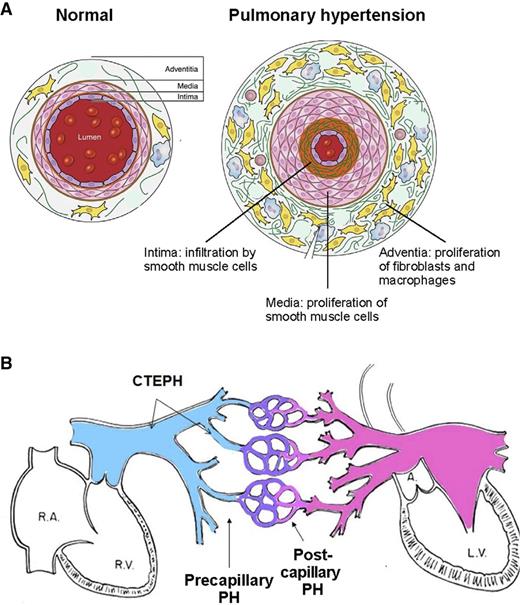 Figure 1. Schematic representations of pulmonary hypertension. (A) Schematic cross-sectional representation of a normal pulmonary arteriole and a pulmonary arteriole affected by pulmonary hypertension. (Adapted from Pugliese et al.7) (B) Schematic representation of site of initiation of elevated pulmonary arterial pressure of precapillary pulmonary hypertension, postcapillary pulmonary hypertension, and CTEPH. L.V., left ventricle; PH, pulmonary hypertension; R.A., right atrium; R.V., right ventricle.