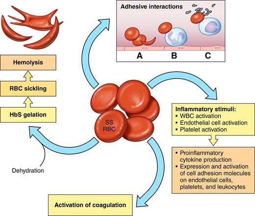 Figure 1. The sickle red blood cell (SS RBC) as source of multiple pathophysiologic pathways. Red cells with predominantly HbS (SS RBCs) become rapidly dehydrated, which increases the propensity of HbS to polymerize when deoxygenated. Pharmacologic reagents that prevent dehydration may therefore also reduce HbS polymerization and hemolysis. Altered lipid sidedness (phosphatidylserine exposure) may play a role in SS RBC adhesion and also promote activation of coagulation. Oxidative damage of red cell membrane proteins likely contributes to altered cell elasticity. Abnormal adhesive properties lead to SS RBC adhesion to endothelial cells (A), SS RBC adhesion to neutrophils (B), and adhesive interactions that result in heterocellular aggregate formation involving SS RBCs, monocytes, and platelets (C). Abnormal intracellular signaling increases the activation state of red cell adhesion molecules, and increased adhesive interactions then lead to abnormally active cell-cell signaling, which leads to activation of both other blood cells and endothelial cells. Both SS RBCs and hypoxia/reperfusion also lead to activation of inflammatory pathways involving both mononuclear and polymorphonuclear leukocytes. Platelet activation also contributes to inflammatory pathways as well as activation of coagulation.