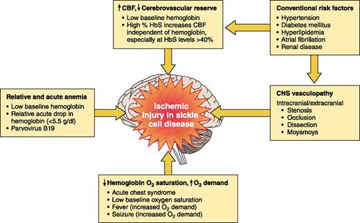 Figure 2. Risk factors for ischemic stroke in SCA. Established risk factors for ischemic injury of the brain in children and adults with SCA.