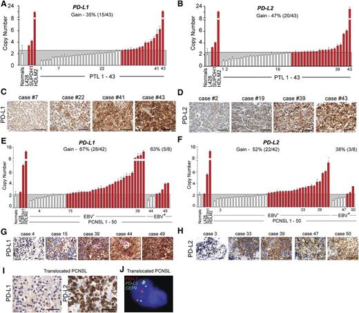 Figure 6. Genetic alterations of PD-L1 and PD-L2 in PTL and PCNSL. (A) CNs of PD-L1 in 43 PTL cases from the extension cohort. Normals include 5 tonsils and 5 reactive lymph nodes. The upper 95% confidence interval of the normals was used as a threshold for CN gain in the PTLs. Indicated cHL cell lines with known PD-L1 copy gain were used as controls. Cases with copy gain are highlighted in red. Error bars reflect standard deviation. (C) PD-L1 protein expression in indicated cases from (A). The scale bar represents 100 μm. (B) CNs of PD-L2 in 43 PTL cases from extension cohort. Controls are as in (A). (D) PD-L2 protein expression in indicated cases from (B). (E) CNs of PD-L1 in 50 PCSNL cases (42 EBV– and 8 EBV+) from the extension cohort. Details are as in (A). (F) CNs of PD-L2 in 50 PCSNL cases (42 EBV– and 8 EBV+) from extension cohort. Controls are as in (A). (G) PD-L1 protein expression in indicated cases from (E). The scale bar represents 100 μm. (H) PD-L2 protein expression in indicated cases from (F). (I) PD-L1 (left panel) and PD-L2 (right panel) of the PCNSL case with wild-type PD-L1/2 CN. (J) Split-apart FISH assay of the PCNSL in (I). PD-L1 in red, PD-L2 in green and centromeric probe (CEP9) in aqua.