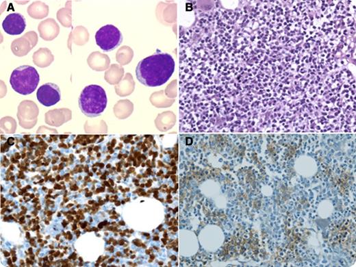 A 55-year-old woman presented with a 3-month history of severe transfusion-dependent anemia. Physical examination revealed pale skin but no hepatosplenomegaly or lymphadenopathy. A complete blood count showed normocytic anemia (4.6 g/dL; mean cell volume, 90 fL) with reticulocytopenia (3 × 109/L) and normal leukocyte and platelet counts. Bone marrow smears (panel A) and biopsy specimen (panel B) showed extensive infiltration (65%) by CD20+ CD5+ CD23− cyclin D1+ lymphoid cells, with a marked reduction of erythroblasts (1%). Cytogenetics analysis revealed a complex karyotype with t(11;14). Parvovirus B19 serology was negative, as was the polymerase chain reaction performed on bone marrow. The patient was diagnosed with mantle cell lymphoma (MCL) complicated by pure red cell aplasia (PRCA). Cytarabine-based chemotherapy combined with rituximab led to rapid transfusion independency and complete disappearance of bone marrow infiltration (panel C, cyclin D1 expression before treatment; panel D, glycophorin expression after treatment). / PRCA is a rare disorder, defined by the presence of severe normocytic anemia, reticulocytopenia, and a profound reduction of the bone marrow erythroid precursors. Its association with lymphoproliferative disorders is infrequent, mainly described with T-cell large granular lymphocyte leukemia, angioimmunoblastic T-cell lymphoma, chronic lymphocytic leukemia, diffuse large B-cell lymphoma, and follicular lymphoma. Only 1 case of PRCA associated with MCL has been described so far, also presenting in a nonnodal form of MCL but occurring later in the course of the disease and responding only to immunosuppressive therapy.