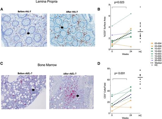 Figure 7. Tissue distribution of CD3+ T cells after rhIL-7 treatment. Eight study patients and 17 HCs underwent flexible sigmoidoscopy with rectosigmoid biopsy for immunohistochemical analysis. (A) Representative image of CD3+ staining of the lamina propria in a study patient before and after rIL-7 treatment. The black arrows indicate areas of positive CD3 staining. (B) Percentage of lamina propria surface area staining positive for CD3 in each of the 8 patients with rectosigmoid biopsies before (week 0) and after (week 24) 3 doses of rhIL-7 treatment as well as the values for the HCs. Each patient’s results are depicted by color and symbol, as in Figure 1. HCs are depicted as black diamonds, and the straight horizontal line shows the median value for the HCs. (C) Seven study patients and 10 HCs underwent bone marrow biopsy for immunohistochemical staining for CD3. (C) Representative image of CD3+staining in the bone marrow before and after rIL-7 in a study patient. The black arrows indicate areas of positive CD3 staining. (D) Mean number of CD3+ cells per high power field for each of the 7 patients with bone marrow biopsies before and after rhIL-7 treatment. The color scheme and symbols are the same as those used in (B).