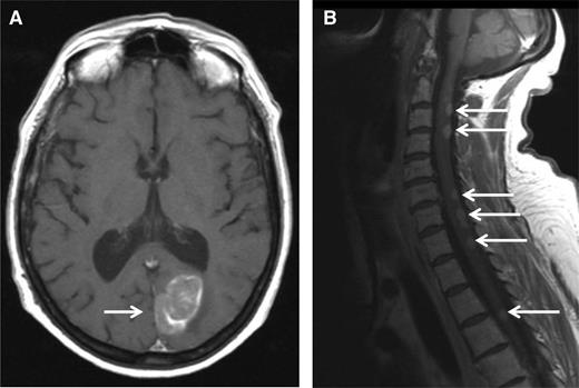 Figure 1. MRI. MRI (T1 weighted) showing an occipital mass with leptomeningeal involvement (A, white arrow) and multiple posterior medullary lesions (B, white arrows), in a relapsed MM patient who developed progressive ataxia.