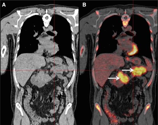 Figure 2. PET-CT scan. PET-CT scan (A) demonstrating increased FDG avidity of the pancreas (B, arrows) in an MM patient who developed epigastric pain during maintenance therapy.