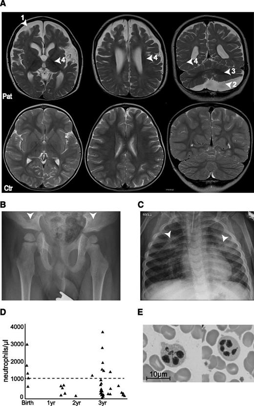 Figure 1. Clinical phenotype of the patient. (A) Magnetic resonance imaging (MRI) scans of the brain at 3.5 years (upper row), with arrowheads indicating (1) atrophy of the telencephalon, (2) arachnoidal cyst in the posterior fossa, (3) insufficient myelination, and (4) enlarged external and internal cerebrospinal fluid spaces. The lower row shows MRI scans of a healthy 3.5-year-old child. (B) X-ray of the pelvis showing flat, dyplastic acetabulae. (C) X-rays of the chest showing chronic interstitial pneumonia. (D) Neutrophil counts over time. Dashed line at 1000 neutrophiles/µL represents the clinical limit for neutropenia. (E) Bone marrow smear showing hypersegmented neutrophils.