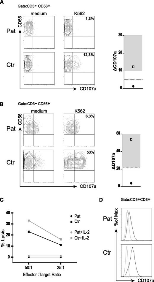 Figure 2. Impaired degranulation and cytotoxicity of patient NK cells. (A) Ex vivo degranulation of NK cells (CD3–CD56+) from the patient (Pat) and a healthy donor control (Ctr) after incubation with medium (left panel) or with K562 cells (middle panel) as assessed by flow cytometric analysis of CD107a surface expression. The right panel shows the difference in CD107a expression between unstimulated and stimulated cells from the patient (solid circle) and a day control (open square) relative to healthy controls (gray shaded area). The dashed line represents the level below which NK-cell degranulation has the best positive and negative predictive value for a mutation in a gene relevant for cytotoxicity in an unfiltered cohort of patients with HLH. (B) Degranulation of NK cells prestimulated with IL-2 and PHA for 48 hours. (C) Cytotoxicity of patient and control PBMCs on K562 target cells without (black symbols) or after overnight pre-incubation with IL-2 (gray symbols). (D) T-cell degranulation. Cultured T cells from the patient and a healthy control were incubated in medium or stimulated with 3 µg/mL of plate-bound anti-CD3. The increase in CD107a expression upon stimulation is shown as an overlay of histograms of unstimulated (dotted line) and stimulated (solid line) cells.