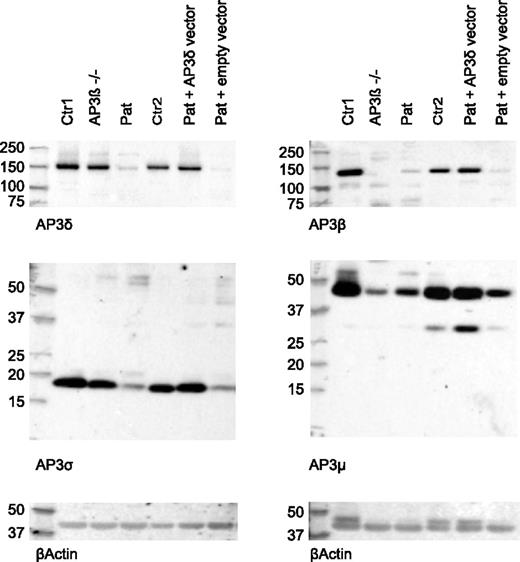 Figure 4. Reduced expression of AP3δ affects the stability of the AP3 complex. Western blot analysis of lysates from magnetically activated cell sorter (MACS) –purified CD8 T cells of 2 healthy controls: an AP3β3A-deficient patient and the index patient (lanes 1-4). Two separate blots are shown that used rabbit antibodies against AP3δ and AP3σ (left) and AP3β and AP3μ (right). β-actin was used as a loading control. AP3δ protein was analyzed by using 2 different antibodies23,24 in 3 independent experiments with similar results. Lanes 5 and 6 show blots from patient PHA/IL-2 blasts retrovirally transduced with an AP3D1-expressing or empty vector analyzed in the same experiment. These cells were sorted by using fluorescence-activated cell sorting (FACS) for GFP-positive cells to enrich for successfully transduced cells.