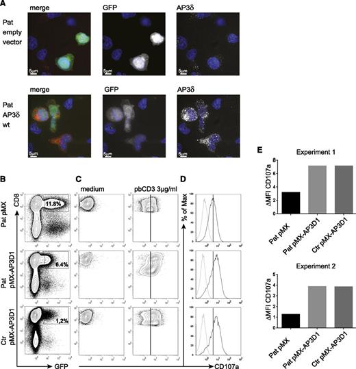 Figure 5. Genetic reconstitution with wild-type AP3D1 restores expression and function of the AP3 complex. (A) Immunofluorescence analysis of patient PHA/IL-2 blasts reconstituted with either empty vector or wild-type AP3D1 using mouse anti-AP3δ (SA4). Cells are shown in one 3D stack picture of 28 slices. Cells successfully transduced with the vector are GFP-positive (white in the single stains and green in the merged picture), the nucleus is stained with Hoechst (blue), and AP3δ is stained with SA4 provided by A. Peden18 (white in the single stains and red in the merged picture). The variable GFP intensity of reconstituted cells is explained by the use of an IRES-GFP construct in which AP3D1 is placed before and GFP is placed after the IRES sequence. (B) Transduced T cells were rested in medium free of IL-2 for 24 hours and then incubated in medium or stimulated with 3 µg/mL plate-bound CD3 for 3 hours. Transduction efficiencies varied between 1% and 12%. (C) CD107a expression after incubation of transduced cells with medium or plate-bound anti-CD3. Plots are gated on successfully transduced GFP-positive CD8+ cells. The solid line indicates peak CD107a expression in patient cells transduced with the empty vector. (D) Overlay of CD107a expression of transduced T cells kept in medium (dotted line) and (E) stimulated with anti-CD3 (solid line). The difference in mean fluorescence intensity (ΔMFI) of CD107a expression between cells incubated in medium vs stimulated with plate-bound anti-CD3 is shown for patient (Pat) and control (ctr) GFP-positive CD8+ T cells transduced with the indicated vector. Results are shown from 2 independent experiments.