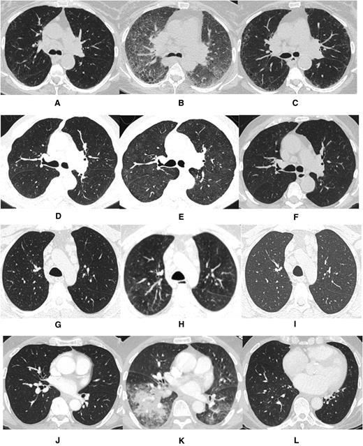 Figure 1. Computed tomography imaging for each case prior to ibrutinib exposure, during pneumonitis while on ibrutinib, and following ibrutinib discontinuation. (A,D,G,J) Pre-ibrutinib; (B,E,H,K) during ibrutinib; (C,F,I,L) post-ibrutinib.