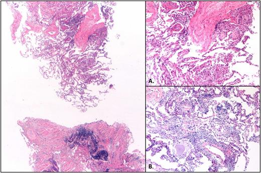 Figure 2. Hematoxylin and eosin–stained sections reveal patchy lung parenchymal involvement by intra-alveolar loose fibrous plugs, intra-alveolar fibrin, reactive pneumocytes, and mild chronic interstitial inflammation (×2.5). (A) Higher magnification (×10) of loose fibrous plugs in alveolar spaces and indistinct granuloma. (B) Higher magnification (×10) of focus with chronic interstitial inflammation.