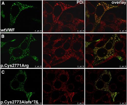 Figure 5. Colocalization of VWF and PDI. wtVWF (A) or VWF mutants p.Cys2771Arg (B) and p.Cys2773Alafs*76 (C) were transiently expressed in HEK293 cells. Forty-eight hours after transfection, cells were fixed and VWF proteins and PDI were detected by indirect immunofluorescence employing rabbit anti-VWF and mouse anti-PDI antibodies; secondary antibodies were goat anti-rabbitAF488 and goat anti-mouseAF546. Images were recorded with a confocal microscope (TCS SP5, Leica), using an HC PL APO CS2 63.0 × 1.40 oil ultraviolet objective and the following settings: image size of 512 × 512 pixels, laser power of the 543 and 488 lasers was set to 9% and 20%, respectively. Colocalization appears yellow in the overlay images; for colocalization analysis, please refer to supplemental Table 1. Scale bars represent 10 µm.