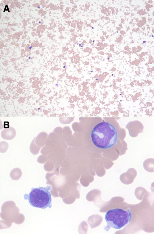 A 16-year-old boy presented with 2 weeks of fevers, night sweats, fatigue, and myalgia, in addition to an erythematous rash on the trunk and extremities after new findings of hepatosplenomegaly and inguinal lymphadenopathy. Monospot test was positive, confirming the diagnosis of infectious mononucleosis. Cytomegalovirus immunoglobulin (Ig)G and IgM antibodies were normal at <10 titers. Epstein-Barr virus (EBV) IgG antibody to early antigen was elevated at 20 titers (normal is <10 titers), and both the EBV IgG and IgM antibodies to capsid antigen were elevated at 640 titers (normal is <10 titers). Laboratory studies showed a hemoglobin level of 6.1 g/dL and a platelet count of 64 × 109/L. Direct antiglobulin test (DAT) was negative using anti-IgG and weakly positive using anti-C3d. In the peripheral blood smear, atypical reactive lymphocytes and striking agglutination of red blood cells were seen (panels A-B). / Red cell agglutinins are infrequently seen in infectious mononucleosis (∼1% of cases) and have been ascribed to polyclonal IgG/IgM cold agglutinins specific for the i antigen on the red cells. The weakly positive DAT using anti-C3d and the negative DAT using anti-IgG are characteristic for infectious mononucleosis, indicative of complement-mediated intravascular hemolysis that can occur 1 to 2 weeks after infection.