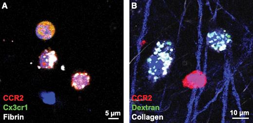 CCR2-positive cells endocytose fibrin, but not collagen. Cells positive for both CCR2 and CX3cr1 are identified by orange/yellow staining and show uptake of fibrin in white in panel A, whereas uptake of collagen, shown in white in panel B, is accomplished by cells that are negative for CCR2. Thus, cells that endocytose collagen are clearly distinct from cells that endocytose fibrin. See Figure 3H-I in the article by Motley et al that begins on page 1085.