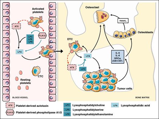 Figure 2. Role of nontumoral ATX derived from platelet α-granules in LPA production promoting bone metastasis of breast cancer cells. Interaction of CTCs with platelets induces the generation of LPA through the secretion of LPA and LPA precursors involving phospholipase A1/A2 activities and lysopholipase D activity of ATX released from α-granules.39 Then, LPA promotes transendothelial cell migration and establishment of a disseminated tumor cell into the bone marrow.81 LPA enhances tumor cell proliferation and induces bone resorption through a direct action on osteoclasts54 and indirectly throughout the secretion of anti-(GM-CSF) and pro-osteoclastic factors (IL-6, IL-8, GROα) that also act directly on osteoclasts or indirectly on osteoblasts by upregulating the release of the pro-osteoclastic factor RANKL.38,53 Figure was generated using the database of images from Servier Medical Art from Servier (http://creativecommons.org/licenses/by/3.0/fr/).