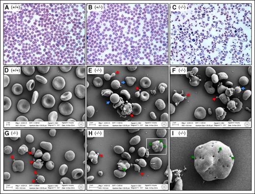 Figure 3. Aberrant erythrocyte morphology. (A-C) Wright-Giemsa stain of peripheral blood smears from 3-week-old mice. Shown at ×60 original magnification. (D-I) Scanning electron microscopy of peripheral blood cells of 18-week-old mice. Shown at ×4000 original magnification. Blue arrows show spherocytes; red arrows show extensive microcytic vesiculation and protruding structures; and green arrows show many invaginations in FLKO erythrocytes/reticulocytes. (I) An enlarged view of the rectangle area shown in H to highlight the presence of multiple invaginations in a single cell. (+/+), WT; (+/−), heterozygous; (−/−), dematin FLKO.