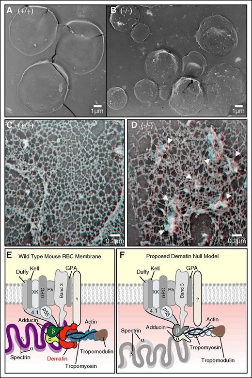 Figure 6. Transmission electron microscopy of erythrocyte membrane skeleton. Dematin FLKO erythrocytes are immature and have grossly deranged membrane skeletons. Comparison of the surface topology of (A) WT and (B) dematin FLKO erythrocytes. The structure of dematin FLKO erythrocytes is replete with invaginations that correspond to coated pits. (A) WT mature erythrocytes have a featureless surface. The skeleton underlying the membrane of dematin FLKO erythrocytes is abnormal, having many focal disruptions in the (D) spectrin-based skeleton compared with the (C) WT membrane skeleton. Bars correspond to 0.2 μm. Statistical analysis of the pore size was performed. Mann-Whitney test, 2-tailed, P < .0001. (E-F) Proposed model of dematin–membrane complex. Dematin and adducin coanchor the spectrin–actin complex to the erythrocyte plasma membrane. (E) Note that the mouse erythrocyte membrane does not contain any glucose transporter-1 (GLUT1), and therefore the receptor that links dematin to the membrane is not yet known. (F) Deletion of dematin causes rupture of the linkage between the spectrin–actin complex and the plasma membrane due to the secondary loss of adducin, resulting in concomitant decrease of both spectrin and actin at the junctional complex.