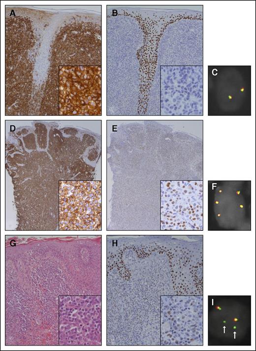 Figure 1. Histologic features of 2 representative patients with primary C-ALCL and a patient with tumor stage MF included as a positive control. The dermis of the first patient with C-ALCL (patient 10) shows a dense dermal infiltrate of CD30+ tumor cells with infiltration of the hair shaft (A). The tumor cells are predominantly negative for p63 (B). FISH with break-apart probes for TP63 (TP63 FISH) shows 2 normal fusion signals (C). The second patient with C-ALCL (patient 4) also shows a dense dermal infiltrate of CD30+ tumor cells (D). The tumor cells variably express p63 (E). TP63 FISH shows 3 extra copies of the fusion signal, indicating gain of chromosome 3 or polyploid tumor cells (F). The hematoxylin and eosin staining of the patient with MF shows some epidermotropism and diffuse infiltration of the dermis by blastic tumor cells (G). The tumor cells variably express p63 (H). TP63 FISH shows 2 fusion signals and 2 separate green signals (I; arrows), suggesting gain of chromosome 3 with an unbalanced translocation of TP63. Note that the epidermis shows expression of p63 in the basal and suprabasal layers (B,E,H). Original magnification ×200 for panels A-B,G-H, ×100 for panels D-E, and ×400 for insets.