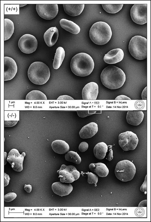 Electron microscope images of wild-type (+/+) and dematin knockout (−/−) erythrocytes, illustrating the membrane disturbance caused by the absence of dematin. The figure has been adapted from Figure 3D,H in the article by Lu et al that begins on page 93.