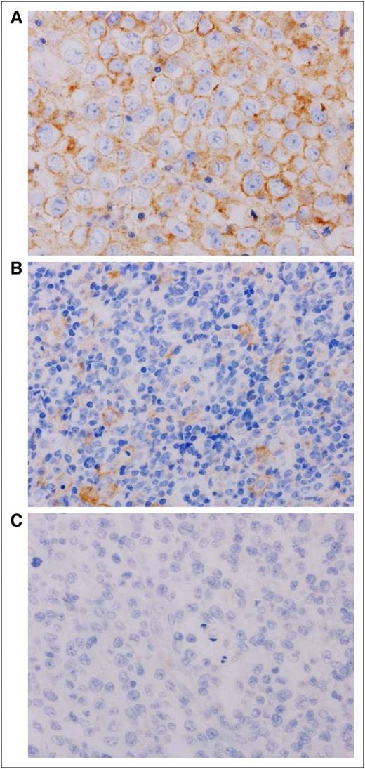 Figure 1. Representative immunohistochemical analysis of PD-L1 expression in ATLL. (A) nPD-L1-positive ATLL. The plasma membranes of neoplastic cells were positive for PD-L1 (brown staining). (B) miPD-L1-positive ATLL. Neoplastic cells were negative for PD-L1. PD-L1-positive nonmalignant stromal cells were observed. Those stromal cells with PD-L1 expression were morphologically consistent with monocyte-derived cells, including macrophage or dendritic cells. (C) PD-L1-negative ATLL. PD-L1 was negative for both neoplastic cells and nonmalignant stromal cells. Original magnification ×600 for all panels.