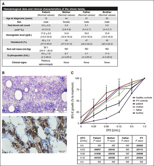 Figure 1. Hematological parameters, clinical data, BM evaluation, and in vitro sensitivity assay of erythroid progenitors to EPO. (A) Hematological and clinical analysis of the propositus and his family members revealed erythrocytosis, plethora, and palpable spleen (splenic length of 12 cm based on ultrasound measurement) in the patient. ND, not done. (B) Patient’s BM aspirate (May-Grünwald-Giemsa staining, top) and BM biopsy (glycophorin C staining specific for erythroid lineage, brown color, bottom) showed hypercellularity, erythroid hyperplasia, normal granulopoiesis, and abnormal megakaryopoiesis (for details, see supplemental Figure 1). The images were visualized with an Olympus BX41 light microscope (Hamburg, Germany) and acquired with an Olympus DP73 camera driven by CellSens Entry software. Images were labeled using Adobe Photoshop software (Adobe Systems, San Jose, CA). Top: magnification, ×100; scale bar, 100 µm. Bottom: magnification, ×200; scale bar, 200 µm. (C) The EPO dose-response curves derived from the patient, patient’s brother, patient’s parents, normal controls, and PV patients. The growth of BFU-E colonies at the indicated concentrations of EPO was expressed as a percentage of maximal EPO stimulation (represented by EPO concentration of 1 U/mL). Erythroid progenitors from the patient (red curve) were hypersensitive to EPO; there was a relatively higher number of BFU-E colonies in comparison with healthy controls (black curve) in low EPO concentrations. The in vitro growth of the erythroid progenitors of both of the patient’s parents (blue and green curve, respectively) also showed slightly increased sensitivity to EPO when compared with normal controls (black curve). The progenitors of the patient’s brother (purple curve) showed normal growth. Two PV patients, positive for the V617F mutation (brown curve), were used as positive controls for hypersensitivity and formation of EPO-independent colonies (EECs). The table below the graph shows statistical evaluation of the BFU-E colony number at individual concentrations with respect to normal controls. P values were calculated using Origin 6.1 software (OriginLab Corporation, Norhampton, MA, USA). *P < .05; **P < .01. NS, not significant.