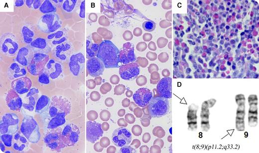 An 8-month-old male infant presented with a diffuse sandpaper-like rash, lymphadenopathy, hepatosplenomegaly, fever, tonsillar hypertrophy, frequent infections, and failure to thrive. Complete blood count showed marked leukocytosis (white blood cell count, 34.91 × 109/L; eosinophils, 23.9%; neutrophils, 43%; monocytes, 10.8%; lymphocytes, 18.5%; immature granulocytes, 3.8%) and anemia (hemoglobin, 7.9 g/dL). Peripheral blood smear revealed leukocytosis with markedly increased neutrophils, eosinophils, monocytes, and occasional immature granulocytes (panel A; Wright's stain, original magnification ×1000). Bone marrow showed myeloid hyperplasia with markedly increased eosinophils (11% of total nucleated cells) and 1% blasts (panels B-C; panel B, Wright-Giemsa stain, original magnification ×1000; panel C, hematoxylin and eosin stain, original magnification ×400). No infectious agent was identified. Cytogenetic analysis showed a 46,XY,t(8;9)(p11.2;q33.2) karyotype in 16 of 20 cells (panel D). Fluorescence in situ hybridization analysis showed FGFR1 rearrangement in 74% of cells. The patient underwent allogeneic unrelated bone marrow transplant and suffered graft-versus-host disease and multiple infections; he died at 19 months of age, 6 months after the transplant. / The differential diagnosis of eosinophilia is broad, and includes a variety of reactive conditions, infections, and malignancies. FGFR1-related myeloid neoplasms with eosinophilia are rare. This is the youngest patient reported in this category. This case highlights that myeloid neoplasms in any age group with unexplained eosinophilia, even without an increase in blasts, should be always considered and investigated with cytogenetics.