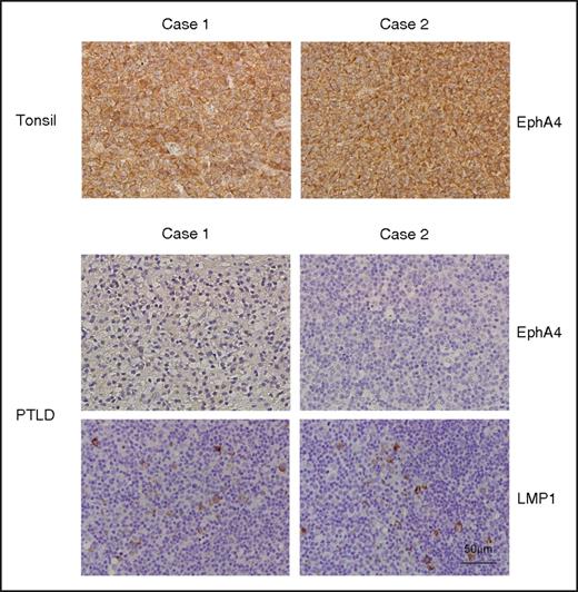 Figure 6. Expression of EphA4 in PTLD biopsies. Paraffin-embedded PTLD and tonsils sections were subjected to IHC assays, and hematoxylin was used for the nuclear counterstaining. Positive signals of EphA4 were indicated as a brown color in tonsil biopsies but not in PTLD biopsies. LMP1 expression was also detected as a brown color by IHC assay in PTLD biopsies. The nuclei of the cells are colored blue. Magnification, ×200 (scale bar, 50 µm).