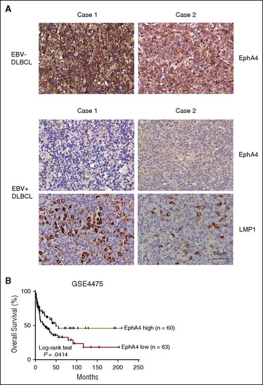 Figure 7. Detection of EphA4 expression in DLBCL biopsies. (A) Paraffin-embedded DLBCL sections were stained for EphA4. Positive signals of EphA4 could be seen as a brown color in EBV− DLBCL, but not in EBV+ DLBCL biopsies, by IHC. LMP1 expression was also detected in EBV+ DLBCL biopsies. The nuclei were observed as a blue color and hematoxylin was used for the nuclear counterstain. Magnification, ×200 (scale bar, 50 µm). (B) This survival curve of DLBCL was obtained from the GEO data sets. Patients were divided into high (n = 60) and low EphA4 (n = 63) groups, according to the median expression level of EphA4. A Kaplan-Meier plot showed that patients with low EphA4 had worse overall survival (P = .0414, log-rank test).
