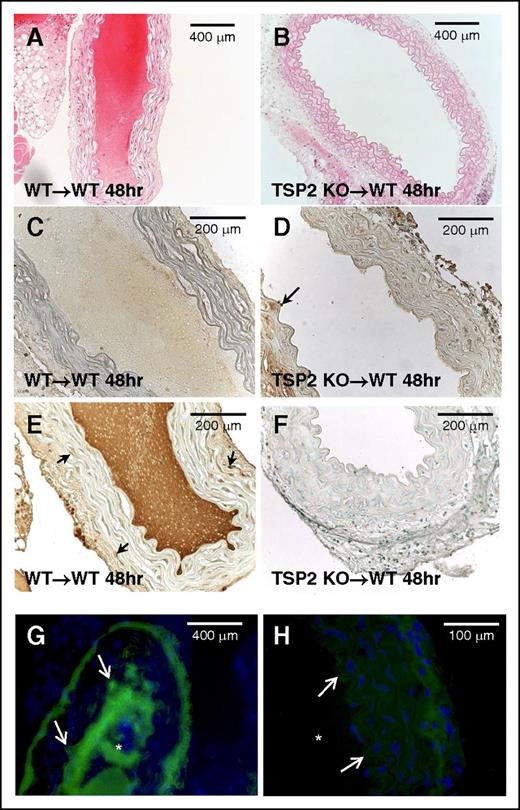 Figure 2. TSP2-null denuded aortic grafts resist thrombosis. Aortic segments from WT and TSP2 KO mice were denuded and grafted in WT mice. Representative images of hematoxylin-and-eosin (H&E)-stained sections of grafts 48 hours following surgery are shown. WT to WT graft (A) is completely occluded whereas the KO to WT graft is fully patent (B) (Zeiss). (C-D) Representative images of WT (C) and TSP2 KO (D) aortic segments immunostained for PECAM-1 (brown color) are shown and demonstrate lack of endothelium. Arrow in D denotes remnants of endothelium. (E-F) Representative images of WT (E) and TSP2 KO (F) aortic segments immunostained for TSP2 (brown color) are shown and demonstrate presence and absence of TSP2, respectively. Arrows in E denote TSP2-immunoreactive cells. (G-H) Representative images of immunofluorescence detection of VWF (green color) in WT (G) and TSP2 KO (H) aortic segments are shown (Zeiss). WT segments show excessive VWF immunoreactivity in the area of thrombus formation, which is absent in TSP2 KO grafts. Asterisk (*) denotes lumen area; arrows denote the vessel edge. Sections were counterstained with methyl green (A-F) or DAPI (G-H). n = 5.