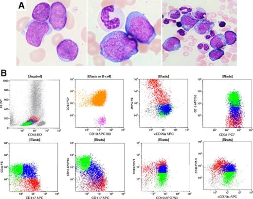A 77-year-old man presented with a past history of gout, hypothyroidism, and persistent thrombocytopenia. Bone marrow examination revealed megakaryocytic hypoplasia and no significant dysplasia. The karyotype was normal. Six years later, he developed severe pancytopenia with rare blasts in peripheral blood. A bone marrow aspirate revealed 34% blasts. Morphologically, blasts varied in size and some showed cytoplasmic granules and abundant cytoplasm (panel A). Erythropoiesis and megakaryopoiesis were markedly reduced, and granulocytic lineage showed prominent dysplasia. Flow cytometry demonstrated a substantial population of CD34+ blasts (panel B, orange shading) that exhibited a complex pattern of lineage-associated markers. One subset expressed B-lineage markers (green): CD19+, CD10+, CD22+, cCD79a+, TdT+, also positive for CD33(dim), CD13, negative for MPO, cCD3; and the other expressed a predominantly myeloid phenotype (red): MPO+, CD117+, CD33+ (bright), CD13+, CD19+, TdT+, cCD79a dim/negative, CD10–, CD22–, cCD3–. An intermediate population could also be detected (blue). Cytogenetic studies showed a complex karyotype: 48XY, –7, +21, +21, +22. Molecular studies for BCR-ABL1 fusion gene were negative. / The diagnosis of acute myeloid leukemia with myelodysplasia-related changes was made and the mixed phenotype of blasts was noted. The final diagnosis in this rare case reflected the current World Health Organization classification in the settings of a complex karyotype including monosomy 7.