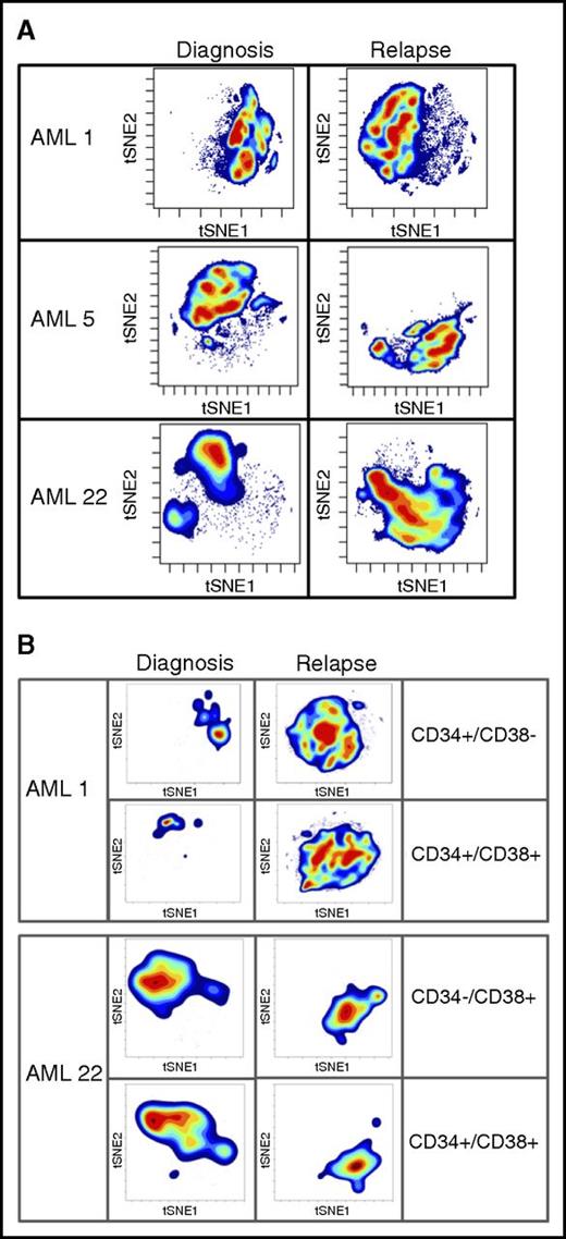 Figure 4. High-dimensional mass cytometry of diagnosis and relapse specimens. (A) The viSNE maps of diagnosis and relapse specimens, as defined by cell surface antigens. High-dimensional mass cytometry was performed on 3 cases (AML1, AML5, and AML22) at diagnosis and relapse, where functional LSC expansion was identified by LDA. viSNE analysis was employed to display the single cell data results, using data from 14 separate cell surface antigens with a Jensen-Shannon Divergence score for pairs AML1, 0.67531; AML5, 0.6808; and AML22, 0.67365. These data indicate the large measurable changes in cellular physiology between diagnosis and relapse for the total mononuclear cell population. (B) The viSNE maps of functionally defined LSC populations at diagnosis and relapse; specimens as defined by cell surface antigens.