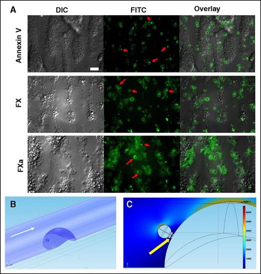Figure 7. Concentration of Annexin V, FX, and FXa on the “caps” in thrombi and its possible significance. (A) Typical epifluorescence microscopy images of platelet aggregates formed after perfusion of hirudinated human whole blood over immobilized collagen at 1000 s−1 (1500 s−1 for FX/FXa) for 5 minutes. Platelet aggregates were visualized using DIC and epifluorescent microscopy (×63 objective). Representative images of DIC and FITC (green) fluorescence of Annexin V, FX, or FXa are shown. Red arrows indicate typical PS-positive platelets with “caps.” Scale bar, 25 μm. (B) Design of a CFD model to evaluate blood flow within and outside of a “cap.” Hemispheric thrombus and procoagulant platelet at its surface are shown in blue. Flow direction is shown with white arrow. (C) Shear rates color map derived from CFD simulation for the central vertical cross-section of the vessel. Maximum shear rate is observed at the top of the “balloon” body of a procoagulant platelet, whereas the minimum values are inside the “cap” (indicated with a yellow arrow).