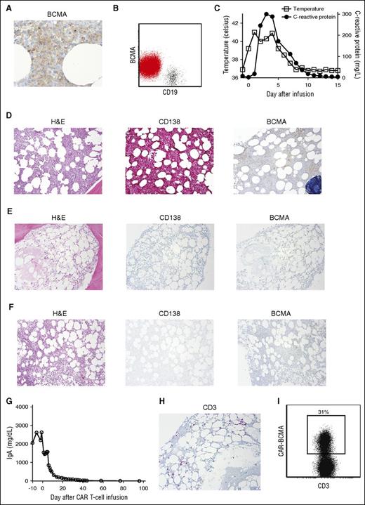 Figure 2. Patient 10 entered a stringent complete remission. (A) Before treatment, patient 10’s bone marrow was stained for BCMA by IHC. BCMA expression was uniform but dim on the MM cells (500×). (B) Flow cytometry of patient 10’s bone marrow showed dim but uniform BCMA expression on the CD19-negative malignant plasma cells (red), whereas BCMA expression was absent on CD19+ B lymphocytes (black). The plot shows a combination of the plasma cell gate (CD38bright, CD138+, CD45dim-negative) and the mature B-cell gate (CD45+, CD19+ lymphocytes). (C) Four hours after CAR-BCMA infusion, patient 10 became febrile. He was febrile for 7 days. The plot shows the maximum temperature for each day. The CRP was elevated. (D) Before initiation of protocol treatment, patient 10 had a hypercellular bone marrow (hematoxylin and eosin). Bone marrow cells were ≥90% plasma cells as shown by CD138 staining. BCMA expression was dim but present. (E) Four weeks after CAR T-cell infusion, the bone marrow was hypocellular, and bone marrow plasma cells were completely absent as shown by the negative CD138 and BCMA staining. (F) Eight weeks after CAR T-cell infusion, the bone marrow was recovering with an overall cellularity of 25%, and plasma cells remained absent. Magnification for D-F was 40×. (G) Immediately before CAR-BCMA infusion, the patient had a serum IgA level of 2633 mg/dL. After CAR T-cell infusion on day 0, serum IgA decreased until reaching undetectable levels. (H) IHC staining of patient 10’s bone marrow showed an infiltrate of CD3+ T cells 4 weeks after CAR T-cell infusion. (I) Flow cytometry with a PE-BCMA-Fc reagent showed that 31% of bone marrow T cells were CAR-BCMA T cells 4 weeks after CAR T-cell infusion. The plot is gated on CD45+ and CD3+ lymphocytes.
