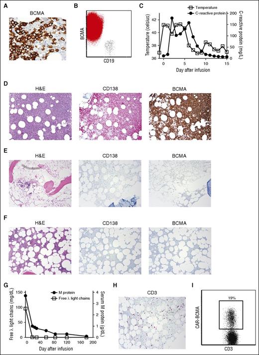 Figure 3. MM was eliminated from the bone marrow of patient 11 after CAR-BCMA infusion. (A) Before treatment, BCMA expression was uniform and strong on the MM cells of patient 11 (500×). (B) Flow cytometry showed strong uniform BCMA expression on CD19-negative malignant plasma cells (red), whereas BCMA expression was absent on CD19+ B lymphocytes (black). The plot shows a combination of the plasma cell gate (CD38bright, CD138+, CD45dim-negative) and the mature B-cell gate (CD45+, CD19+ lymphocytes). (C) Four hours after CAR-BCMA infusion, patient 11 became febrile. He was febrile until 5 days after the CAR T-cell infusion. The plot shows the maximum temperature for each day. The CRP was also elevated. (D) Before protocol treatment, patient 11 had a hypercellular bone marrow (hematoxylin and eosin ). Bone marrow cells were 80% plasma cells as shown by CD138 staining. (E) Four weeks after CAR T-cell infusion, the bone marrow was hypocellular, and bone marrow plasma cells were completely absent as shown by negative CD138 and BCMA staining. (F) Eight weeks after CAR T-cell infusion, the marrow was recovering with an overall cellularity of 20%; plasma cells remained absent. Magnification for D-F was 40×. (G) Before protocol treatment, the patient’s serum λ free light chains level was 95.9 mg/dL. The λ free light chains decreased to an undetectable level after CAR-BCMA T-cell infusion. Before treatment, the patient had an IgG λ M-protein level of 3.7 g/dL. The M-protein decreased after treatment. (H) Patient 11’s bone marrow contained an infiltrate of CD3+ T cells 4 weeks after CAR T-cell infusion. (I) Flow cytometry with PE-BCMA-Fc showed that 19% of bone marrow T cells were CAR-BCMA T cells 4 weeks after CAR T-cell infusion. The plot is gated on CD45+, CD3+ lymphocytes.