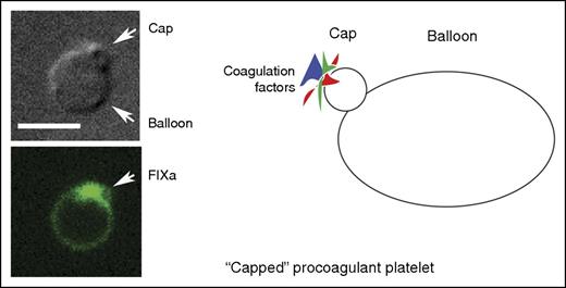 A “capped” procoagulant platelet as shown by differential interference contrast microscopy, fluorescence microscopy (green, factor IXa labeling), and in cartoon form. Scale bar, 5 μm. Micrographs are from Figure 2A in the article by Podoplelova et al. See the complete figure in the article by Podoplelova et al that begins on page 1745.