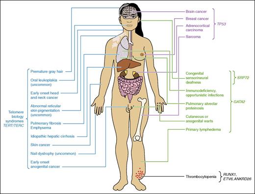 Figure 1. Physical manifestations of the known HMMSs. It is vital that the personal and family history include details regarding nonhematopoietic processes as HMMSs can present in a syndromic manner with multiple organ systems involved. Adapted from Churpek and Godley36 with permission.