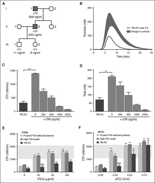 Figure 1. Reduced thrombin generation in the study cases and response to rFVIIa and aPCC. (A) Pedigree of the study cases with traumatic bleeding indicated by the solid symbols and no abnormal bleeding by open symbols. Genotyped cases are indicated as +/V for the heterozygous THBDN p.Cys537Stop variant and +/+ for reference sequence. Plasma TM concentrations are indicated beneath each pedigree symbol. (B) A representative thrombin generation curve from case II.2 in recalcified plasma collected into 0.106 mM trisodium citrate, following activation with 1 pM tissue factor. The gray shading represents the limits of thrombin generation curves observed in 20 healthy controls. (C-D) Plasma ETP peak thrombin concentration from cases I.1 and II.1 (n = 10) with TM-AC and in plasma from 20 healthy controls in the absence or presence of recombinant C-terminal truncated human TM (sTM; 250-2500 ng/mL; high-TM model plasma). (E-F) ETP in plasma from cases I.1 and II.1 and in high-TM model plasma containing 500 ng/mL sTM and either 25 to 100 μg/mL rFVIIa or 0.25 to 0.75 U/mL aPCC. Statistical comparisons are between ETP values in the presence of the stated concentration of bypassing agent vs ETP in the corresponding sample with no added bypassing agent. The gray boxes indicate the range of ETP observed in 20 healthy control plasmas without addition of sTM. Data are means ± SEM; **P ≤ .01. NS, not significant.