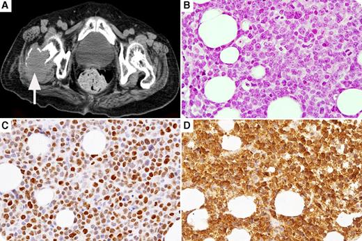 An 83-year-old woman was admitted for diplopia. She was initially diagnosed with cyclin D3–positive mantle cell lymphoma (MCL; which tested positive for CD5, CD20, and SOX11, but was negative for cyclin D1, cyclin D2, and 37% Ki-67 index) in the pterygopalatine fossa with a good response to radiation. She had a relapse in the pterygopalatine fossa and experienced bone lesions, including in the right femur (panel A, computed tomography scan), with drowsiness caused by hypercalcemia, 1 year later. Laboratory tests showed the following: albumin, 2.1 g/dL; calcium, 11.6 mg/dL; parathyroid hormone, 5 pg/mL; and parathyroid hormone–related protein (PTHrP), 3.9 pmol/L (normal, <1.1 pmol/L). Histological findings were consistent with transformation to the cyclin D3–positive blastoid variant of MCL (MCL-BV), retaining the same immunophenotype as initial diagnosis but with an increase in Ki-67 index to 93%. PTHrP expression was observed in lymphoma cells (panel B, hematoxylin and eosin, original magnification ×40; panel C, cyclin D3 immunostain, original magnification ×40; panel D, PTHrP immunostain, original magnification ×40). / A rare subtype of cyclin D1–negative MCL (positive for cyclin D2 or cyclin D3) was reported to be a part of the spectrum of MCL. MCL rarely transforms histologically into MCL-BV, which is more aggressive than typical MCL. Hypercalcemia may have been attributable to both PTHrP production by MCL-BV cells and local osteolytic metastases.