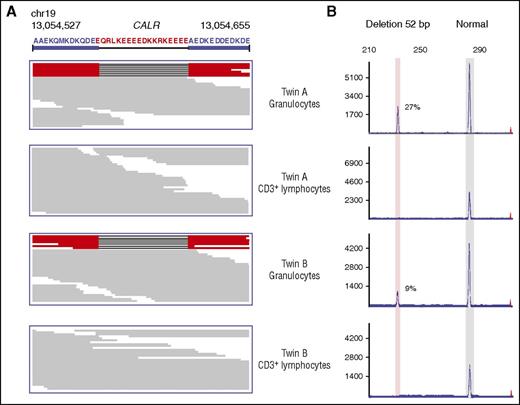 Figure 1. Identification of the type I CALR mutation in the granulocyte fraction of both twins. (A) Results from next-generation sequencing showing the presence of the same 52-bp deletion in the coding region of the CALR gene in DNA obtained from granulocytes but not from CD3+ lymphocytes. (B) DNA fragment analysis using a 5′-fluorescein–labeled primer confirmed the presence of 27% and 9.7% mutant alleles in the granulocyte component in both sisters, while absent in CD3+ lymphocytes.